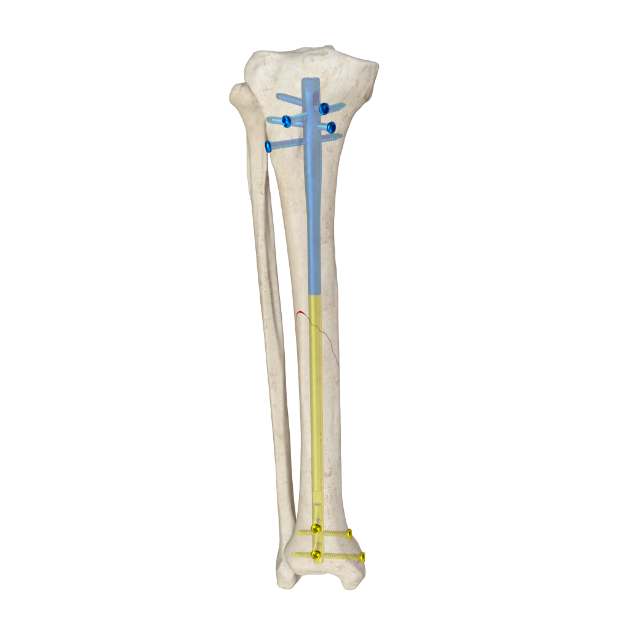MR-IM Tibial Nail