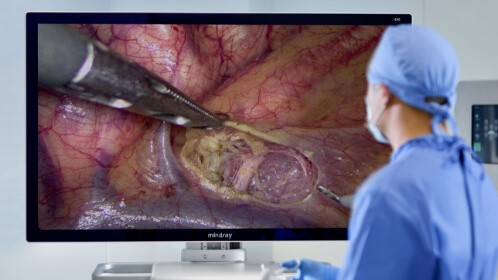 Endoscope Camera for Laparoscopic Surgery