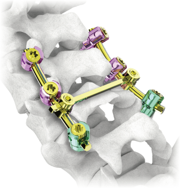 Sistema de tornillo pedicular posterior MS